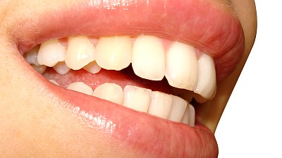 migliorare il sorriso sbiancamento dentale studio dentistico guastalla